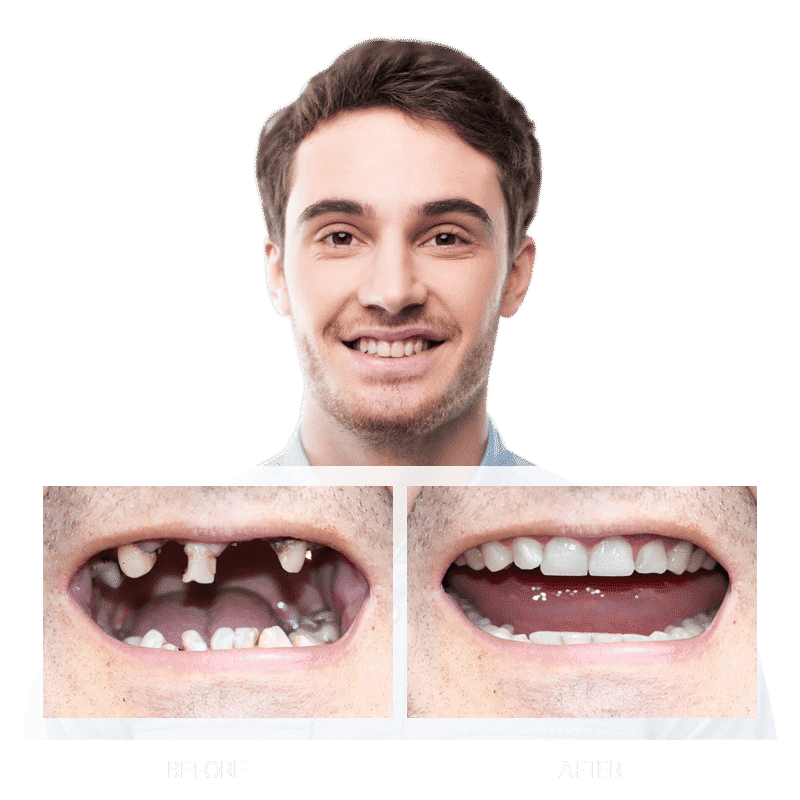 before and after of a male who received dental implants